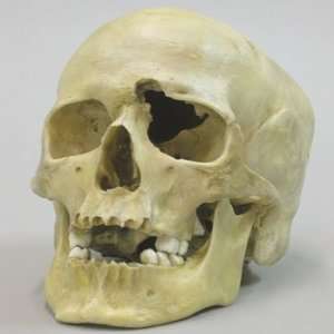 Human Male Skull with a .32 Caliber Gunshot Wound  