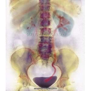 Kidney stone in ureter Framed Prints