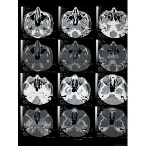  CT Scan Brain Coronal Sect to Orbit and Sinuses 