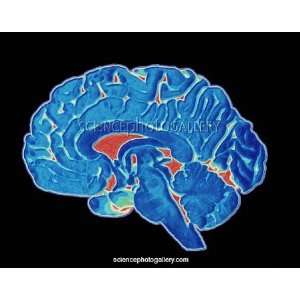  Coloured CT scan of a healthy brain (side view 